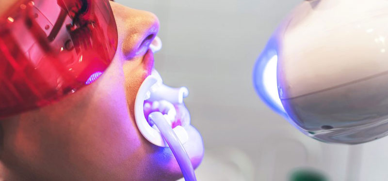 faccette in ceramica o resina composita per denti