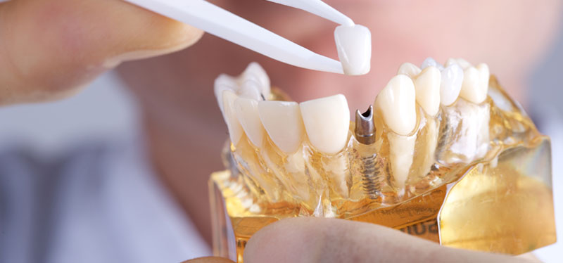 dentista per otturazioni dei denti a Teramo
